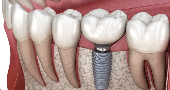 The Life-Changing Benefits of Dental Implants