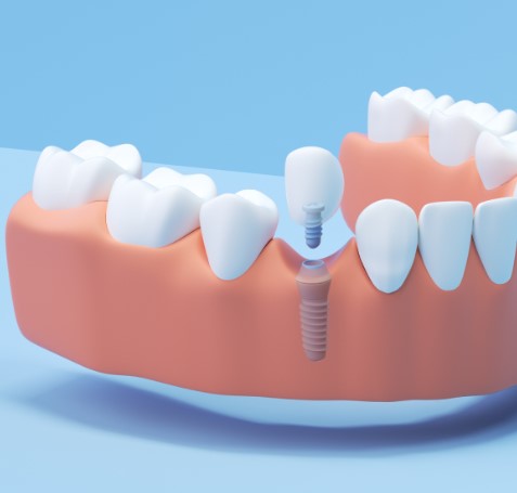The LifeChanging Benefits Of Dental Implants, Transformative Advantages of Dental Implants, Dental Implants